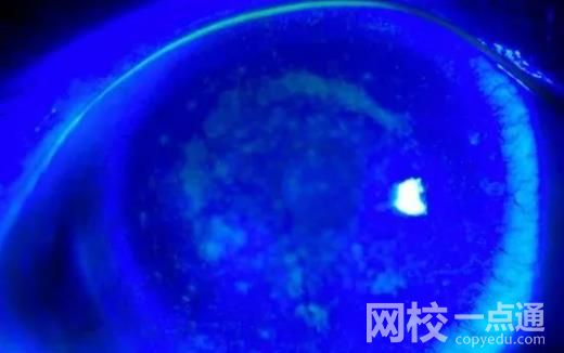 女子戴隱形10年角膜長滿新生血管 具體是什么情況?