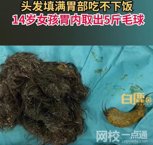 女孩吃頭發胃里取出5斤毛球 孩子異食癖很多年頭發都快薅沒了