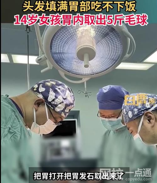 女孩吃頭發(fā)胃里取出5斤毛球 孩子異食癖很多年頭發(fā)都快薅沒(méi)了