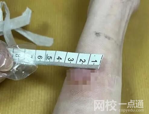 女子稱卷發(fā)棒爆炸致手臂二度燙傷 始料未及真相簡直太崩潰了