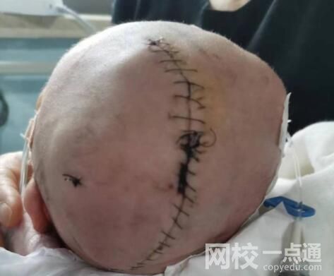 嬰兒出生后顱骨骨折 醫(yī)院回應(yīng) 原因竟是這樣太無奈了