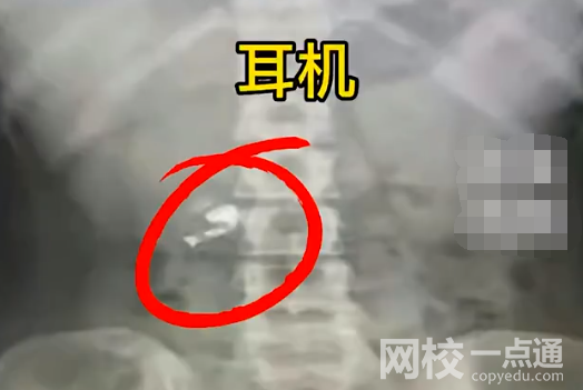 男子誤吞耳機(jī)肚子傳出歌聲 原因竟是這樣簡(jiǎn)直太無(wú)奈了