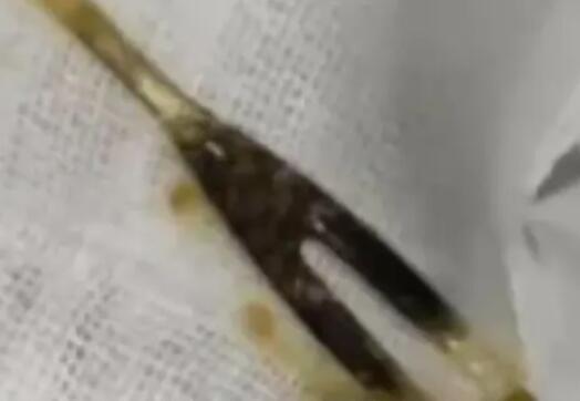 男子腹痛三月以為是腫瘤結果是叉子 到底是怎么進去的？