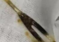 男子腹痛三月以為是腫瘤結果是叉子 到底是怎么進去的？