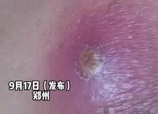 男子擠破身上痘痘住進ICU 實在太恐怖了
