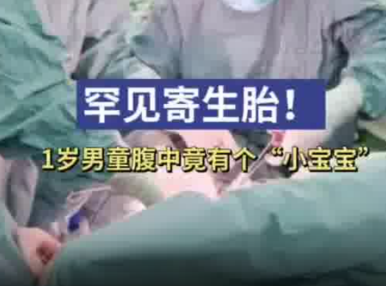 1歲男童腹中竟有個(gè)小寶寶 實(shí)在太罕見了