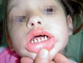 長哪吒同款鯊魚牙可能患有罕見病 究竟是什么樣的？