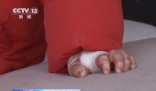 女孩確診“蝴蝶寶貝”皮膚一碰就碎 這也太罕見了