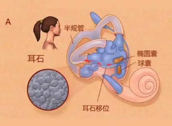 25歲女子長期熬夜打麻將患耳石癥 究竟是怎么回事？