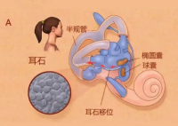 25歲女子長期熬夜打麻將患耳石癥 究竟是怎么回事？