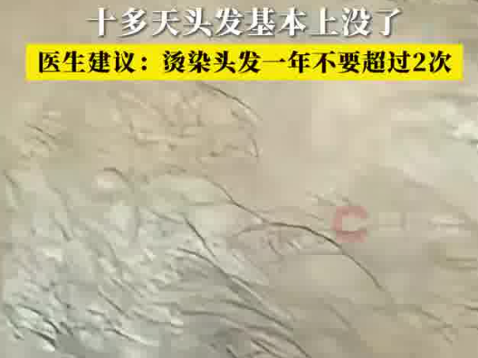 男子一月染頭4次致頭發(fā)大量脫落 實(shí)在太無奈了