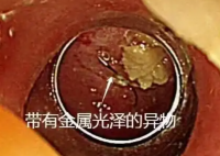老人突發高燒拍胸片意外發現魚鉤 這也太恐怖了