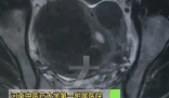 女子愛生悶氣子宮里長了8個(gè)瘤 實(shí)在太恐怖了