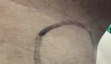 男子甲狀腺結(jié)節(jié)沒在意 2年后癌變 背后真相實(shí)在讓人驚愕
