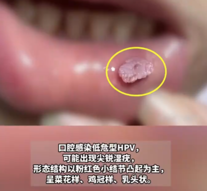 這種口腔潰瘍可能是HPV病毒感染 實在太可怕了
