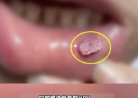 這種口腔潰瘍可能是HPV病毒感染 實在太可怕了
