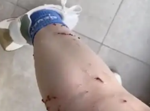 女子被寵物貓咬傷腿部潰爛 究竟是怎么回事？