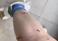 女子被寵物貓咬傷腿部潰爛 究竟是怎么回事？