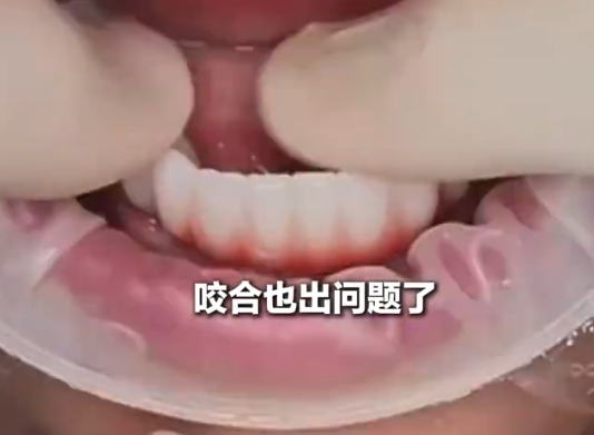 女子花6萬植12顆牙2年調試20多次 究竟是怎么回事？