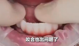 女子花6萬植12顆牙2年調試20多次 究竟是怎么回事？