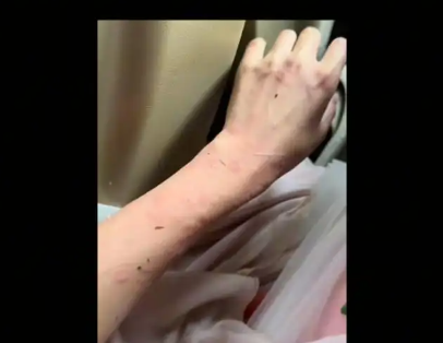 女演員貴州拍戲遇極端天氣 胳膊受傷 實在太嚇人了